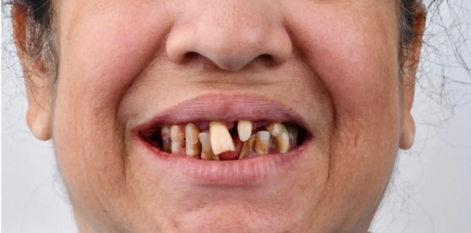 Dental Implant Results